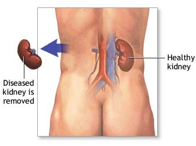 Νεφρεκτομή